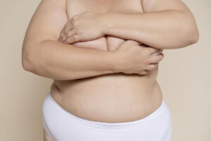 Leia mais sobre o artigo Obesidade tem cura? Tire essa dúvida agora!